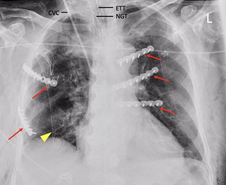 Rib fixation: New horizons in regional surgery - Edorium Journal of Surgery